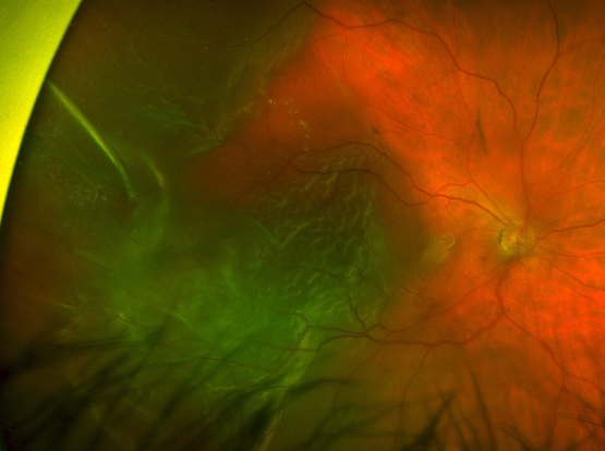 Fundus photo of a macula off retinal detachment.