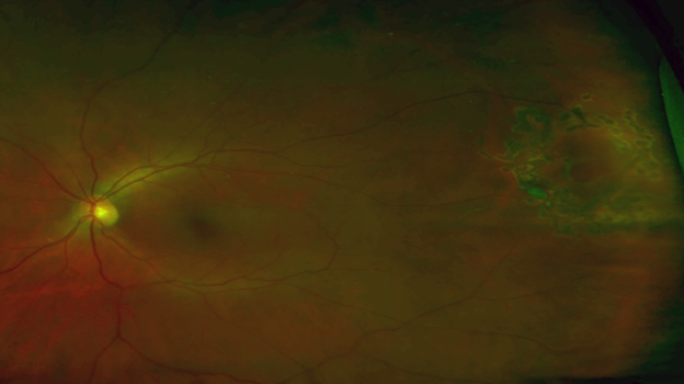 A small horseshoe tear in the temporal periphery, on the right side of the image. Note the flap, small cuff of subretinal fluid, and small intraretinal hemorrhage at the bottom of the tear.
